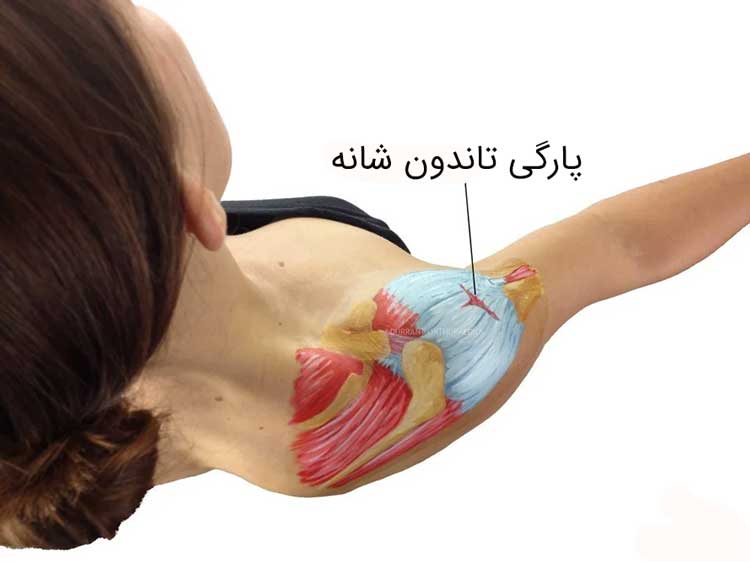 بهترین ورزش پارگی تاندون شانه